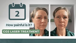 How Painful Is Day 2 After Co2 Laser Treatment [upl. by Doolittle]