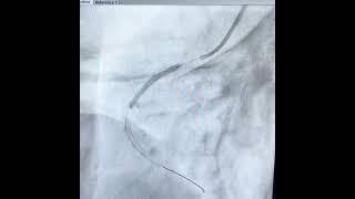 Case 26 Multivessel PCI [upl. by Sergias]