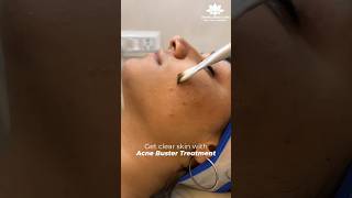 Acne Removal Treatment  acnetreatment acne acneremoval acneproneskin shortsyoutube shorts [upl. by Inness]