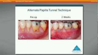 Improve your success with soft tissue grafting using acellular dermal matrix by Dr Edward P Allen [upl. by Namlas]