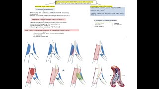 Coronary bifurcation stenting modern algorithms and details of provisional techniques Elias Hanna [upl. by Atnohsal]