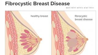 Benign Breast Diseases  ANDI by Prof Dr A P Singh [upl. by Bianchi]