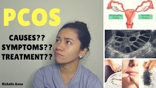 PCOS  Causes Symptoms Treatment  Tagalog [upl. by Otineb]