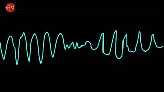 Torsades De Pointes [upl. by Atilef]