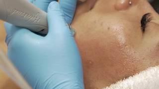 Hydrafacial Treatment and Deep Pore Cleaning [upl. by Nos]