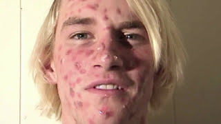 ZIT FACE GUY  PIMPLE ACNE EXPLOSION [upl. by Deckert924]