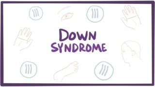 Down syndrome trisomy 21  causes symptoms diagnosis amp pathology [upl. by Burrow189]