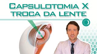 Trocar a lente intraocular após capsulotomia [upl. by Arbmik]