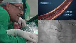 Transradial Intra Vascular Lithotripsy Shockwave IVL at CIMS Hospital [upl. by Oivalf910]