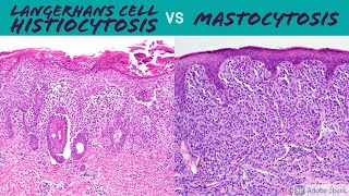 Langerhans Cell Histiocytosis vs Mastocytosis Hemepath for Dermatopathology Pathology Dermatology [upl. by Andri433]