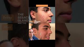 Accure Laser Treatment For Acne Before amp After [upl. by Anawqahs130]