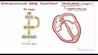 Atrioventricular Nodal Reentrant Tachycardia  Osmosis [upl. by Pierro347]