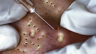 Big Cystic Acne Blackheads Extraction Blackheads amp Milia Whiteheads Removal Pimple Popping 096 [upl. by Buine]