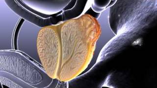 Prostate Cancer Animation [upl. by Constantino]