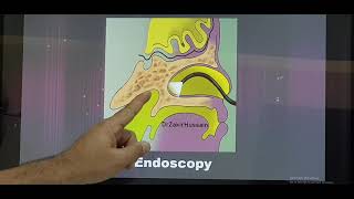 Choanal atresia English Patient teaching programme [upl. by Assirat]