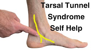 7 Tips for Treating Tarsal Tunnel Syndrome [upl. by Weisler636]