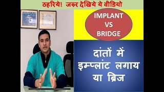 Dental Implant vs Bridge [upl. by Chenay]