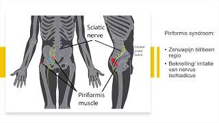 Piriformis syndroom [upl. by Eelidnarb]