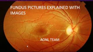 Fundus images explained by an ophthalmologist [upl. by Elinnet]