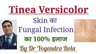 Tinea Versicolor Skin Infection ka 100 Treatment [upl. by Anek]