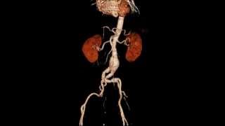 iradka CT 3D aorta aneurysma Radiologie Karlsruhe [upl. by Herzog901]