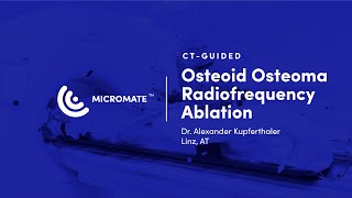 Micromate™  CTguided RoboticAssisted Osteoid Osteoma Radiofrequency Ablation [upl. by Tully]