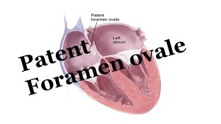 Whats Patent Foramen Ovale PFO Pediatrics [upl. by Telocin332]