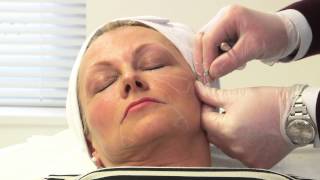 Facial rejuvenation with dermal fillers [upl. by Navarro]