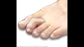 How to treat hammer toes without surgery  Benjamin Marble DPM [upl. by Assele]