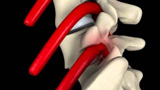 TELDF Spondylolisthesis Animation [upl. by Saticilef]