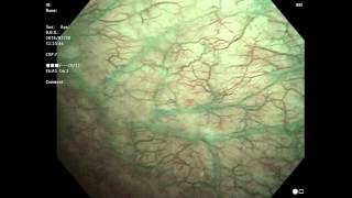 interstitial cystitis 間質性膀胱炎 6回目 膀胱鏡 [upl. by Mirelle335]