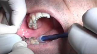 Third molars extraction without pliers and bleeding with piezosurgery in HD [upl. by Pitzer]