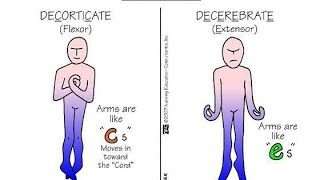 Differences between Decorticate Posturing and Decerebrate Posturing [upl. by Amikan171]