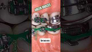 Green Braces Fall Colours Brackets [upl. by Anders360]