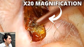 X20 Magnification Ear Wax Removal [upl. by Eisseb]