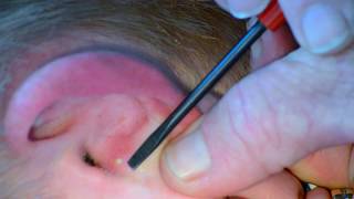 Painful Ear Pimple Popped and Slowly Pressured [upl. by Notterb]