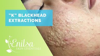 Blackheads Whiteheads Extractions on quotKquot Part 1 [upl. by Nelaf61]