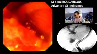 ERCP for Hiliary neoplasic stricture [upl. by Nnaeirrac]