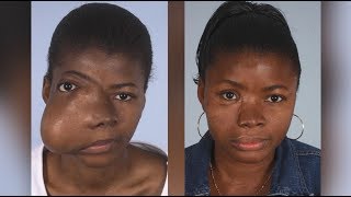 Maxillofacial Surgery Changing Faces Changing Lives  Kadiatus Story [upl. by Nishi]