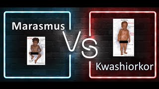 Pediatrics Difference between marasmus and Kwashiorkor PEM Protein energy malnutrition Age Growth [upl. by Dnomse]