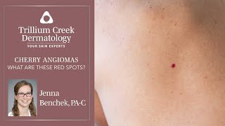 What are Cherry Angiomas [upl. by Virgilia835]