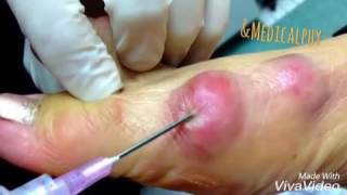 Ganglion cyst aspiration [upl. by Jac369]