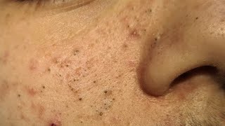 Blackheads Extractions on ¨D¨ [upl. by Rekoob]