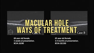 MACULAR HOLE [upl. by Aidam]