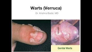 Warts Verruca [upl. by Ayna]