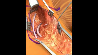 VASCULAR Bypass femoral FASE 46 [upl. by Iatnahs]