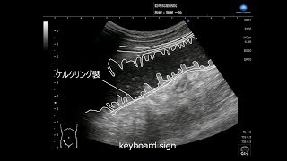 プライマリ・ケアUS動画「イレウス to and fro amp keyboard sign」隠岐島前病院 白石吉彦先生【コニカミノルタ】 [upl. by Henrik414]