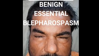 Benign essential blepharospasm BEB shorts [upl. by Thgiwed]