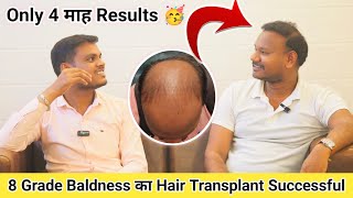 Hair Transplant Raipur Chhattisgarh Hair Transplant Clinic in Raipur 4 Month Hair Transplant Results [upl. by Ahsyle]