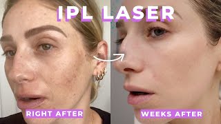 IPL  CLEAR AND BRILLIANT LASER REVIEW  What are they Are they painful Is it worth it [upl. by Singer]